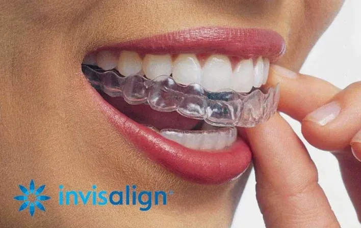Gouttière Invisalign transparente posée sur les dents — traitement orthodontie Luxembourg
