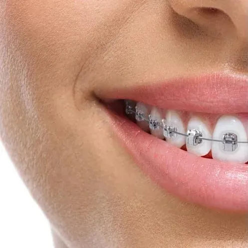 Bagues orthodontiques métalliques sur dents — orthodontie Luxembourg