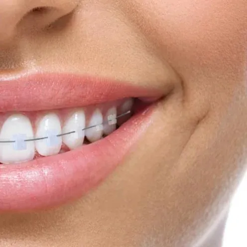 Bagues orthodontiques céramique couleur dent — orthodontie Luxembourg