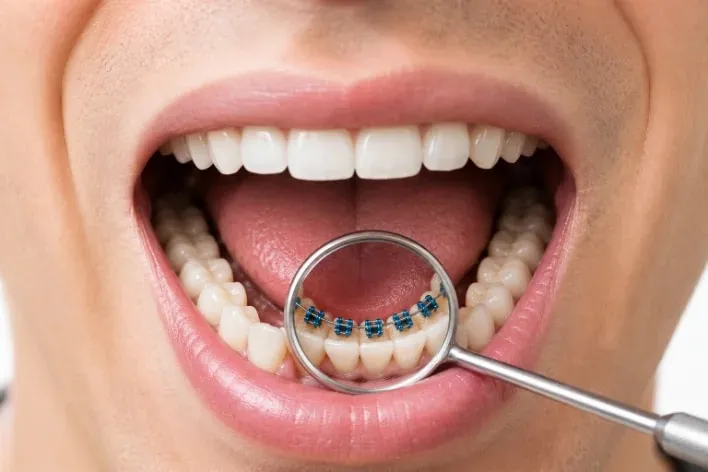Orthodontie linguale posée derrière les dents — orthodontie invisible Luxembourg